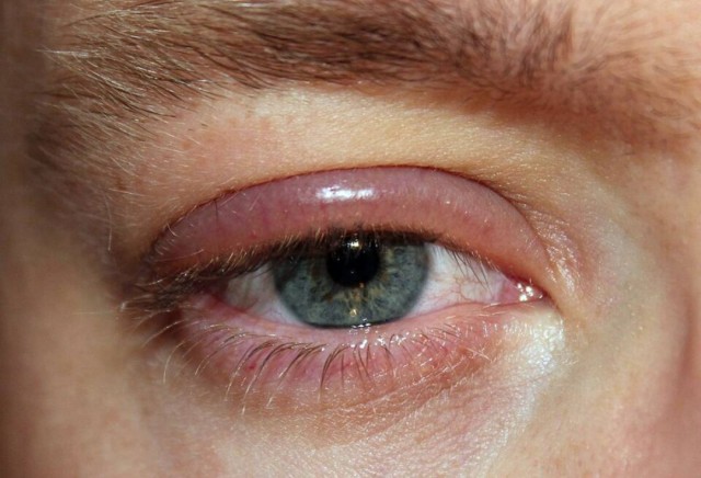 Blefarite, doença crônica que exige limpeza diária dos cílios